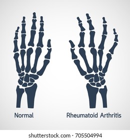 Rheumatoid Arthritis Vector Icon Illustration