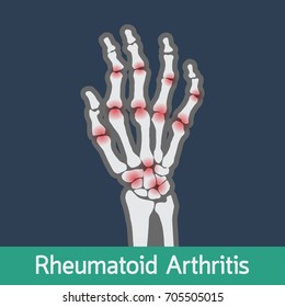 Rheumatoid Arthritis Vector Icon Illustration