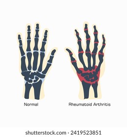 Rheumatoid arthritis vector, illustration. Rheumatoid arthritis pain concept design.