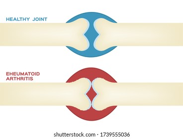 183 Synovial membrane Images, Stock Photos & Vectors | Shutterstock