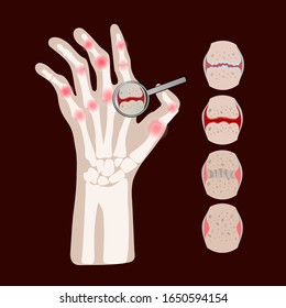 RHEUMATOID DISEASE Arthritis Medicine Education Vector Scheme