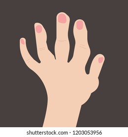 Rheumatoid polyarthritis of hands, arthritis; arthrosis. Vector illustration