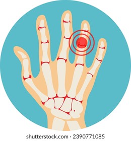 Rheumatoid polyarthritis of hands, arthritis, arthrosis. Аnatomy of the fingers joints. Vector illustration in flat style.