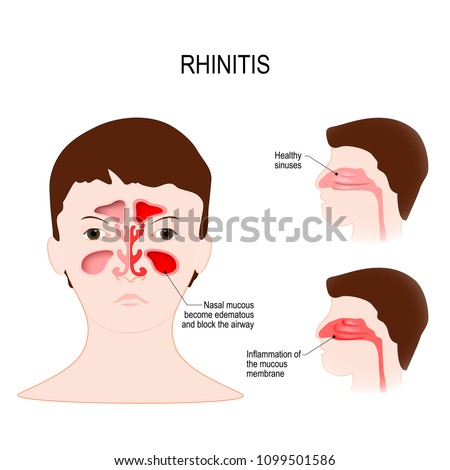 Rhinitis (coryza) is irritation and inflammation of the mucous membrane inside the nose. healthy sinuses and sinuses with inflammation of the mucous membrane