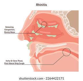 Rhinitis. Irritation and inflammation of the mucous membrane of nasal cavity. Nonallergic or allergic rhinitis symptoms. Flat vector illustration