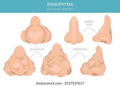 Rinoceronte. Enfermedades nasales. Diseño infográfico médico. Ilustración vectorial