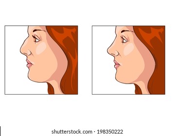 rhinoplasty