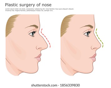 Rhinoplasty aesthetic surgery vector illustration before and after. 