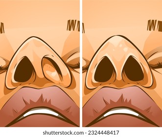 Rhinoplasty, before and after. Correction the shape of the human's nose. Medical illustration. Vector illustration.