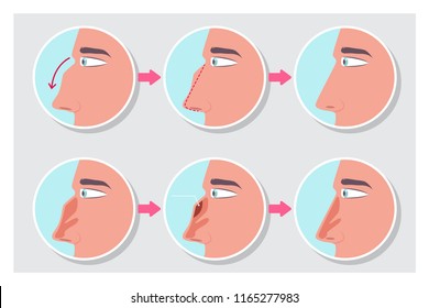 Rhinoplasty before and after the procedure infographics. Nose plastic surgery vector cartoon flat concept medical illustration.