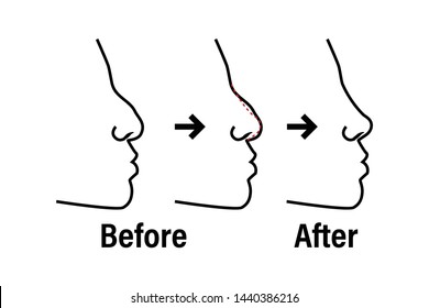 Rhinoplasty before and after the procedure infographics. Nose plastic surgery vector outline concept medical illustration.