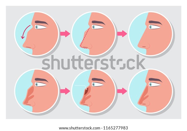 Rhinoplasty Before And After The Procedure Infographics Nose Plastic Surgery Vector Cartoon