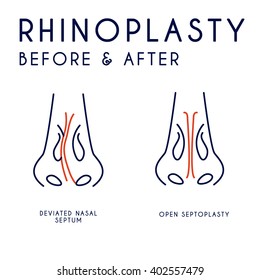 Rhinoplasty illustration. Modern vector style. 