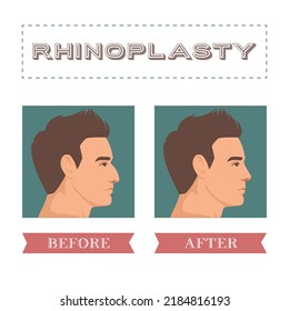 Rhinoplasty, nose surgery. Vector illustration for surgery clinic, hospitals and advertisement. Body correction icons.