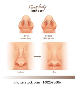 Rhinoplasty. Open and closed rhinoplasty.  bottom view. Plastic surgery nose. For Medical and beauty designs. For your design