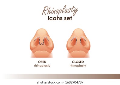 Rhinoplasty. Open and closed rhinoplasty. Bottom view. Plastic surgery nose. Medical and beauty illustration for your design