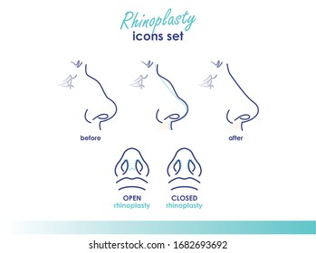 Rhinoplastik. Offene und geschlossene Rhinoplastik. Seiten- und Unteransicht. Nase für plastische Chirurgie. Illustration von medizinischen und Schönheitslinien für Ihr Design