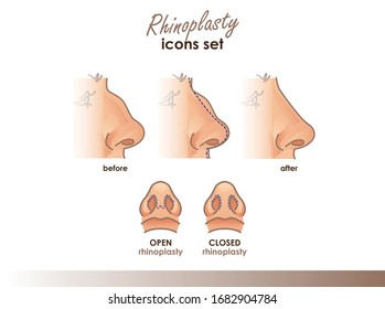 Rhinoplasty. Open and closed rhinoplasty. Side and bottom view. Plastic surgery nose. Medical and beauty illustration for your design