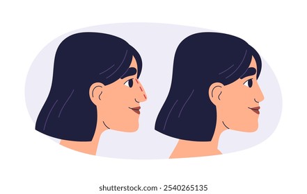 Rinoplastia, cirugía plástica antes y después. Perfil del paciente de la mujer, la nariz que reforma y la mejora estética cosmética, modificación, corrección. Ilustración vectorial plana aislada sobre fondo blanco