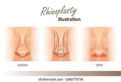 Rhinoplasty. Plastic surgery nose. Front view of a human nose. For medical and beauty advertising design templates