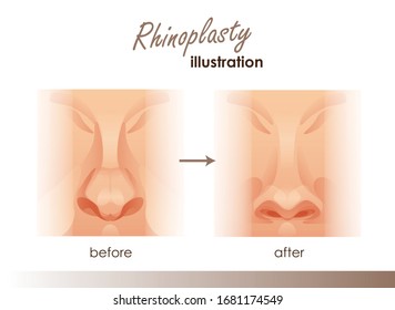 Rhinoplasty. Plastic surgery nose. Front view of a human nose. Before and after illustrations for your design