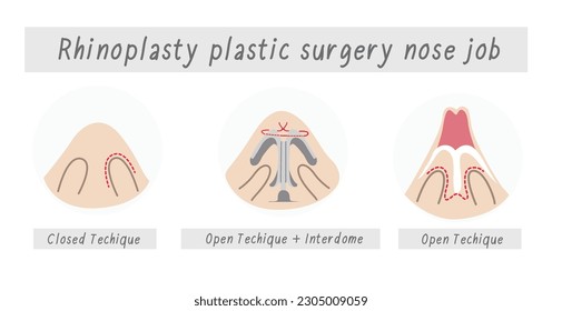 Rhinoplastía cirugía plástica trabajo de nariz, cirugía rinoplastía vector