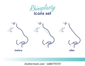 189 Rhinoplasty Advertising Images, Stock Photos & Vectors | Shutterstock