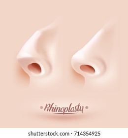 Rhinoplasty surgery example. Nose before and after rhinoplasty. Vector illustration