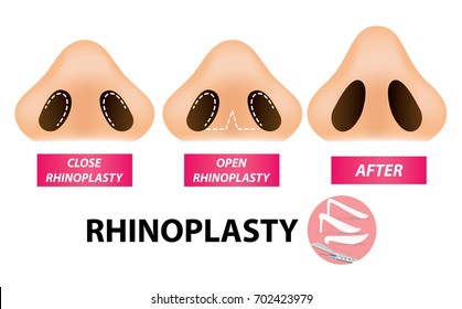 Rhinoplasty surgery vector 