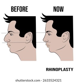 Rhinoplasty, a surgical intervention, mainly resolves the aesthetic problems of the nose.