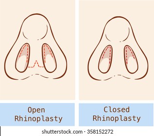 Rhinoplasty technique