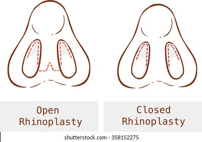 Rhinoplasty technique black and white