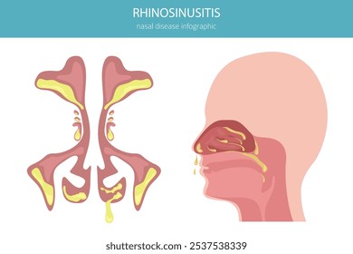 Rhinosinusitis. Nasal diseases. Sinusitis, sinus infection diagnosis and treatment medical infographic design. Vector illustration