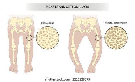 The rickets Blount's and Paget's disease of hip low density lack vitamin D with x-ray the medical anatomy