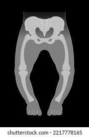 The rickets Blount's and Paget's disease of hip low density lack vitamin D with x-ray the medical anatomy