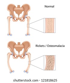 Rickets and Osteomalacia