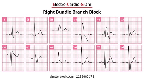 Right Bundle Branch Block - The Differences in ECG Waveform for Each of the 12 Leads - Medical Vector and Illustration