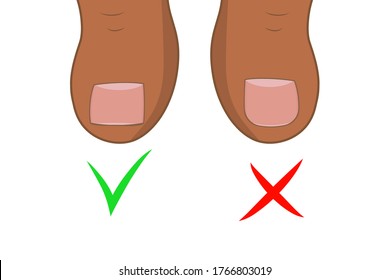 Right to cut toenails. Ingrown toe nail. Pedicure foot sole vector illustration.