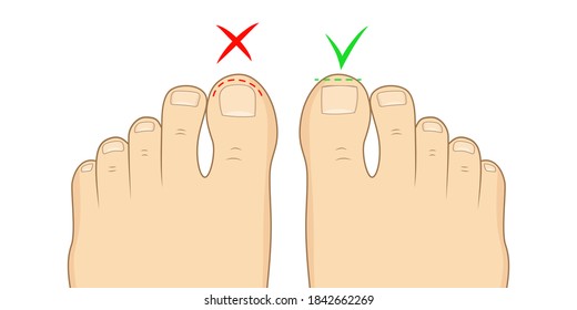 Right to cut toenails. Toe nail pedicure. foot sole vector illustration.