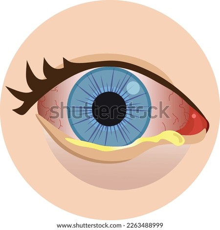 right eye conjunctivitis vetor art