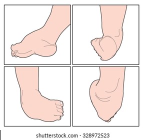Clubfooted Images Stock Photos Vectors Shutterstock