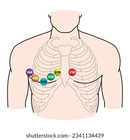 Right Sided ECG Electrode Placement - Electrocardiogram Lead V1R, V2R, V3R, V4R, V5R, V6R Positions - Medical Vector Illustration