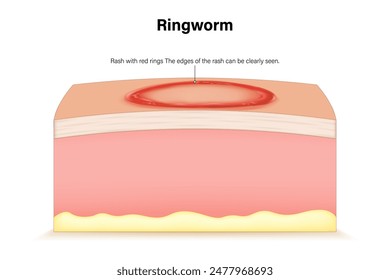 Ringworm eczema psoriasis. Dermatology. Dermatophytosis skin with fungal infection. Caused by fungi from the Dermatophyty group.