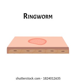 Ringworm on the skin. Vector illustration on isolated background