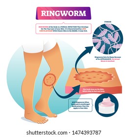 5,259 Ringworm Images, Stock Photos & Vectors | Shutterstock