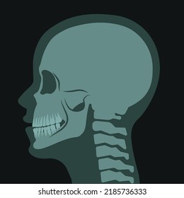 Roentgen Or Tomography, X Ray Of Skull Human Body Anatomy And Diagnosis. Healthcare And Prevention Of Injuries, Cause Of Headache In Head. Trauma Or Pain Strokes. Vector In Flat Style Illustration