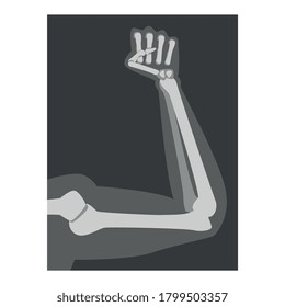 Roentgenograph of Forearm Front View Vector Image
