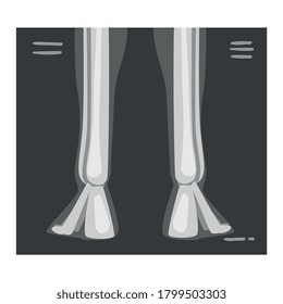 Roentgenograph of Lower Leg Back View Vector Image