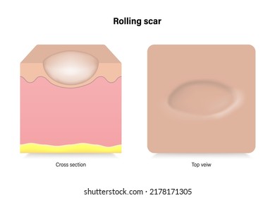 Rolling scar. Facial skin problems. Vector for advertising about beauty and medical treatment.