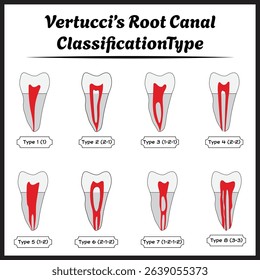 Vertucci’s Root Canal Classification Type Illustration